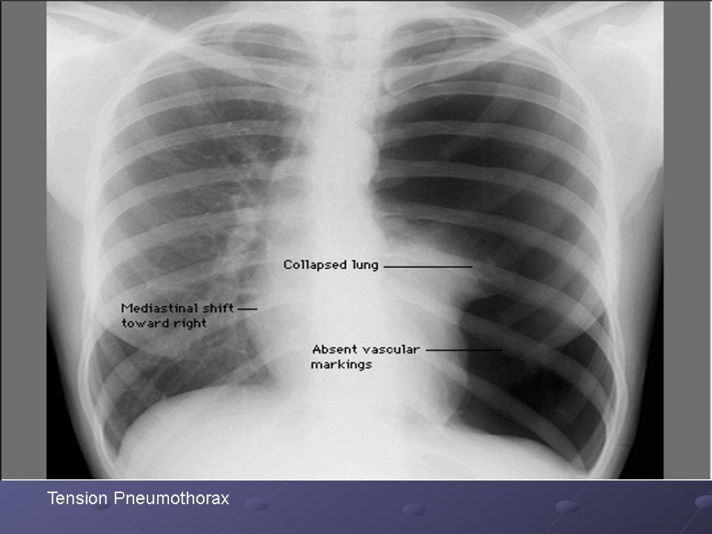 Tension Pneumothorax